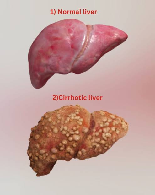लिव्हर सिरॉसिस